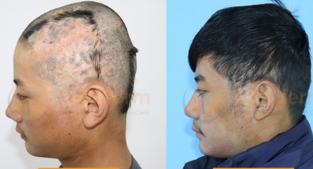  Folliderm — Redefining Hair Restoration Since 2018