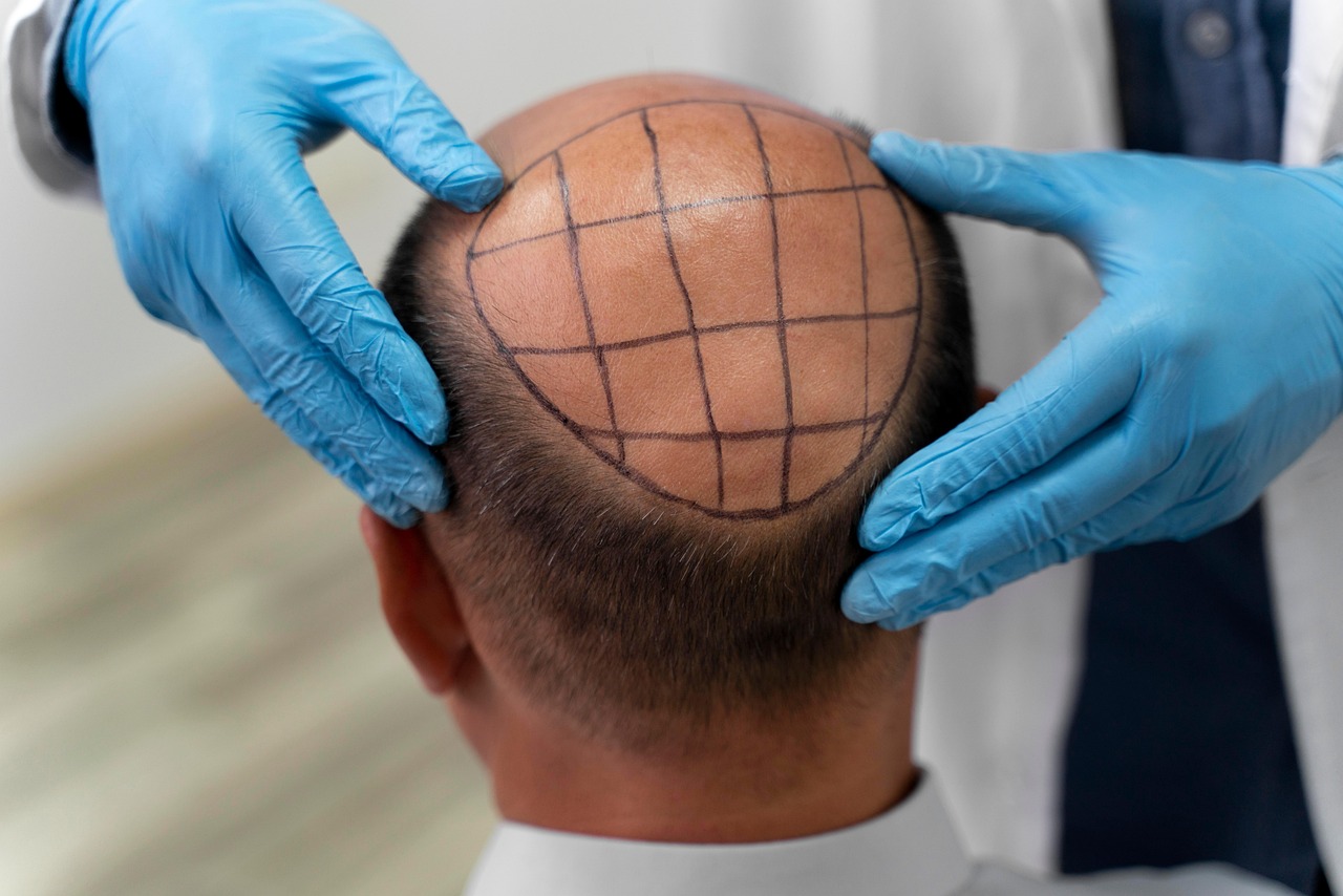  Hair Transplant Surgery